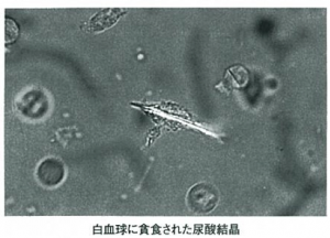 【医師の記事】高尿酸血症と痛風腎